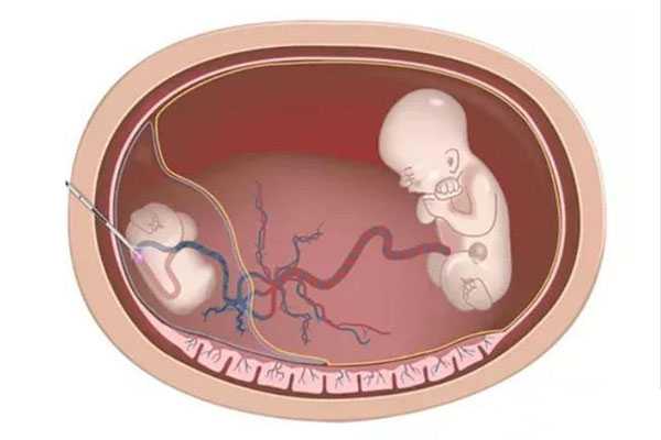 试管婴儿双胞胎减胎风险有哪些？了如指掌，才能胜券在握