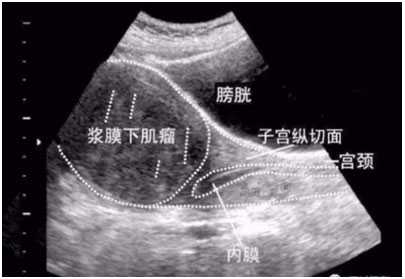 上海试管婴儿移植成功后为什么有些人会不着床，甚至会胎停?